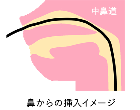 鼻から挿入のイメージ